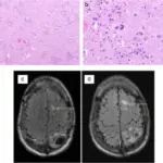 Neurofibromatosis Type 2