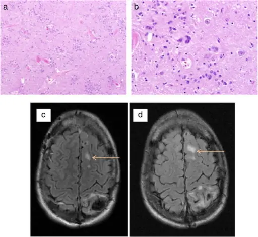 Neurofibromatosis Type 2