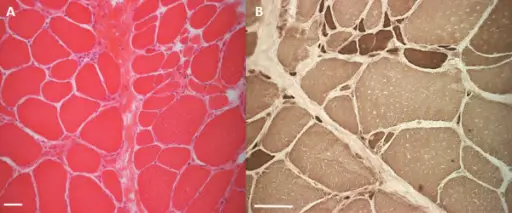 Neurogenic and Myopathic Changes in Skeletal Muscle