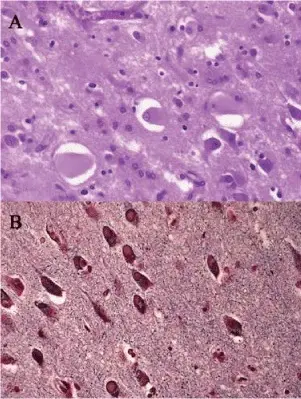 Neuronal Inclusions