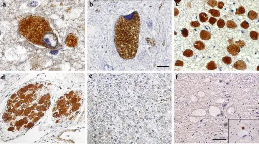 Neuronal Storage Diseases