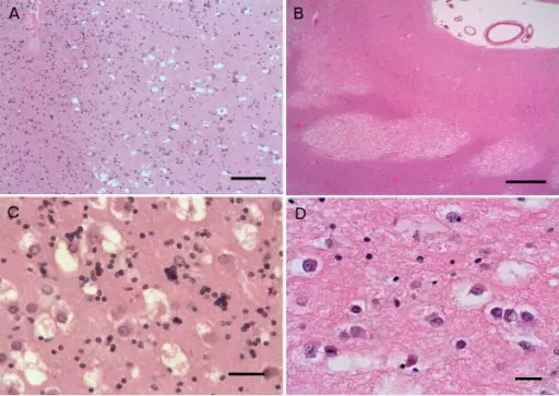 Neuronal Tumors