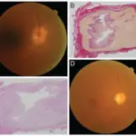 Neuropathy Associated with Systemic Autoimmune Diseases