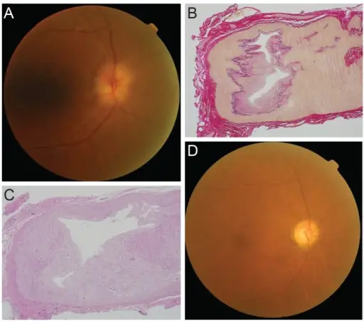 Neuropathy Associated with Systemic Autoimmune Diseases