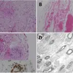 Neuropathy Associated with Vasculitis