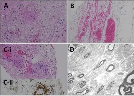 Neuropathy Associated with Vasculitis