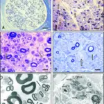 Neuropathy due to Inherited Metabolic Diseases