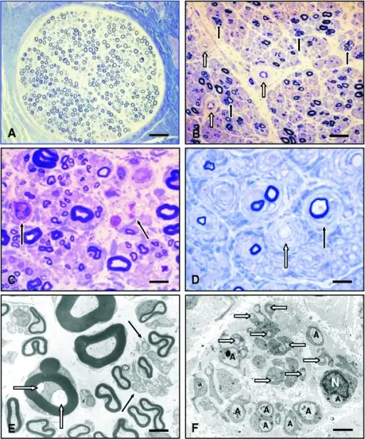 Neuropathy due to Inherited Metabolic Diseases