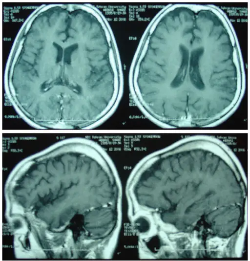 Neuropathy due to Vitamin B12 Deficiency