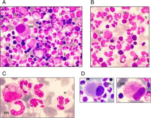 Neutropenia