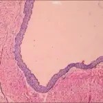 Nevoid Basal Cell Carcinoma Syndrome