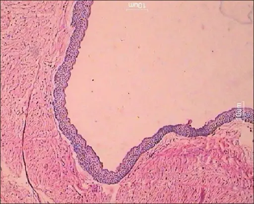 Nevoid Basal Cell Carcinoma Syndrome