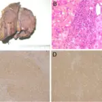 Nodular Hyperplasias of the Liver