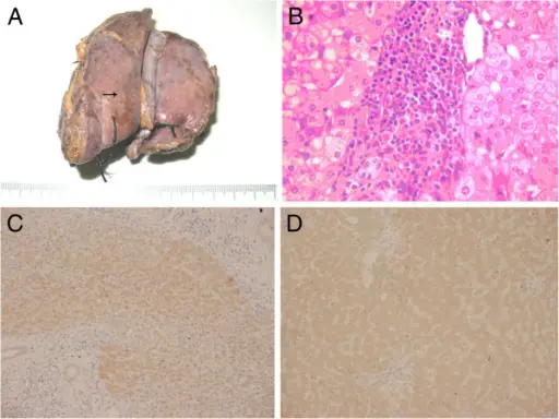 Nodular Hyperplasias of the Liver