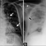 Noncardiogenic Pulmonary Edema