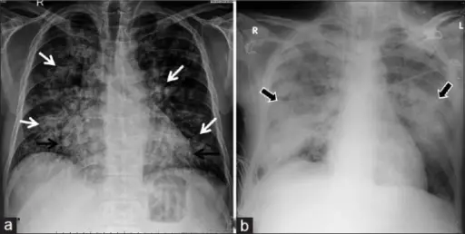 Noncardiogenic Pulmonary Edema