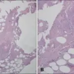 Noninfectious Vasculitis