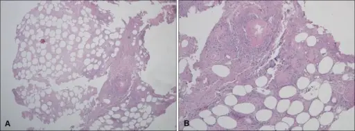 Noninfectious Vasculitis