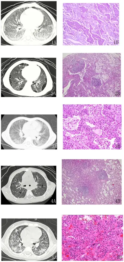 Nonspecific Interstitial Pneumonia