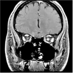 OPTIC NEURITIS