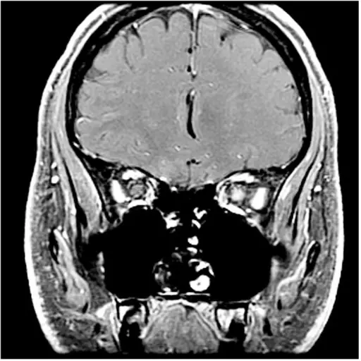 OPTIC NEURITIS