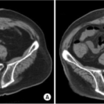 Obstructions of the Ureter