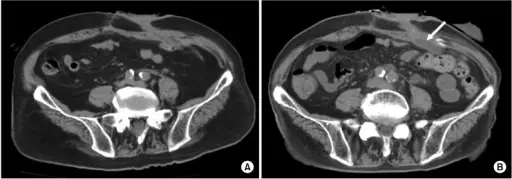 Obstructions of the Ureter