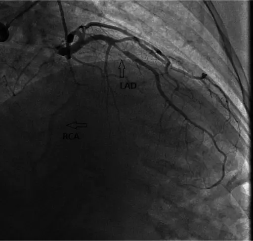 Obstructive Lesions of the Heart