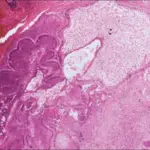 Odontoameloblastoma