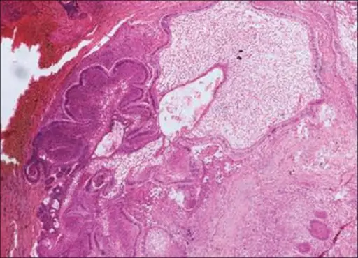 Odontoameloblastoma