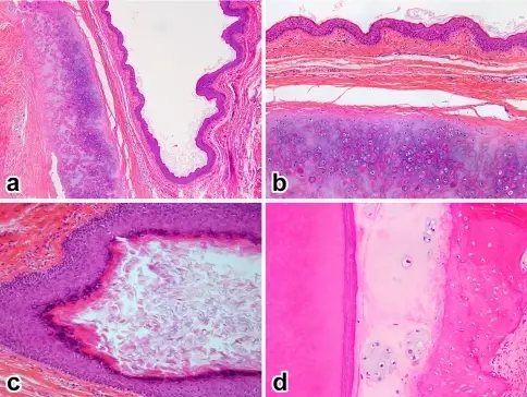 Odontogenic Cysts