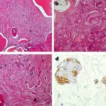 Odontogenic Fibroma