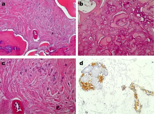 Odontogenic Fibroma