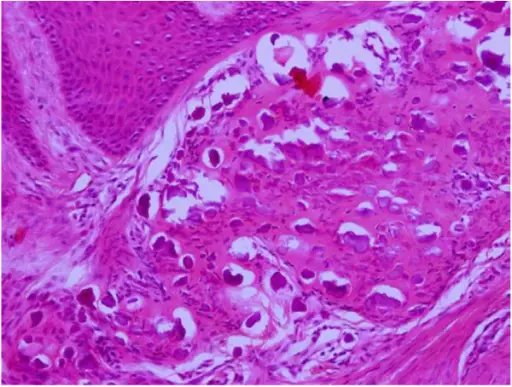 Odontogenic Tumors