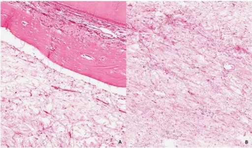 Odontogenic myxoma