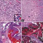 Oligodendrogliomas