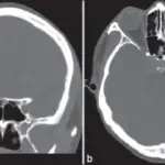 Optic Nerve Damage