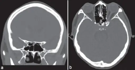 Optic Nerve Damage