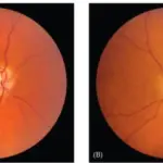 Optic Neuritis