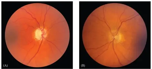 Optic Neuritis