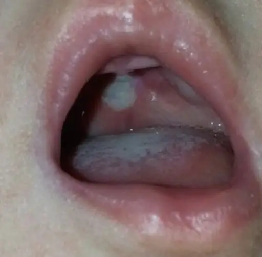 Oral Candidiasis