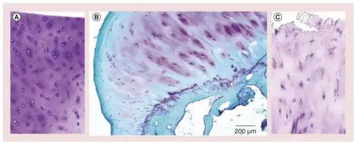 Osteoarthritis