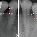 Osteopenia