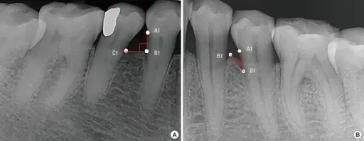 Osteopenia