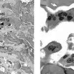 Osteopetrosis