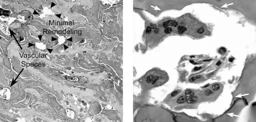 Osteopetrosis