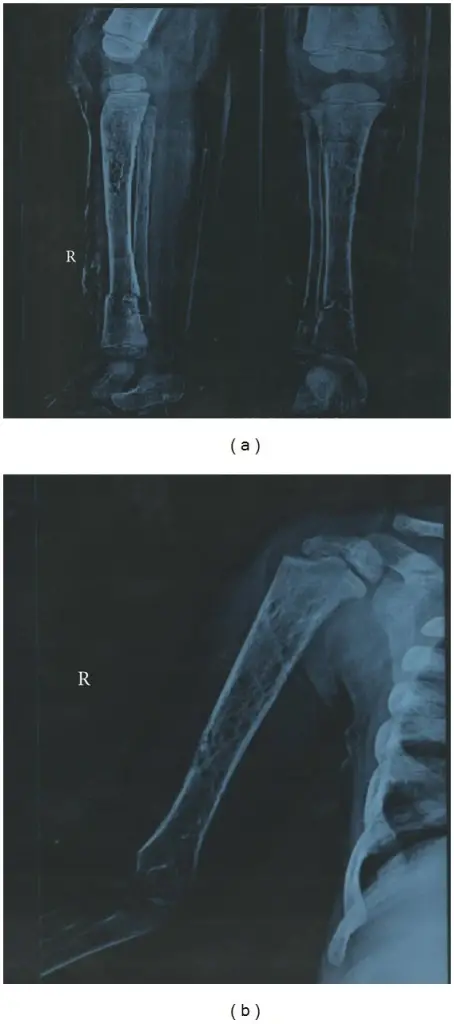 Osteoporosis