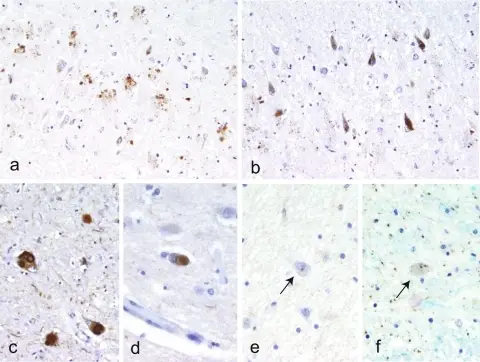 Other Motor Neuron Diseases