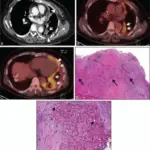 Other Parenchymal Tumors