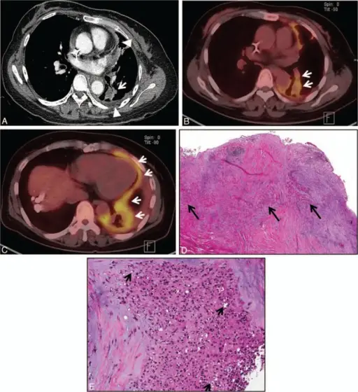 Other Parenchymal Tumors